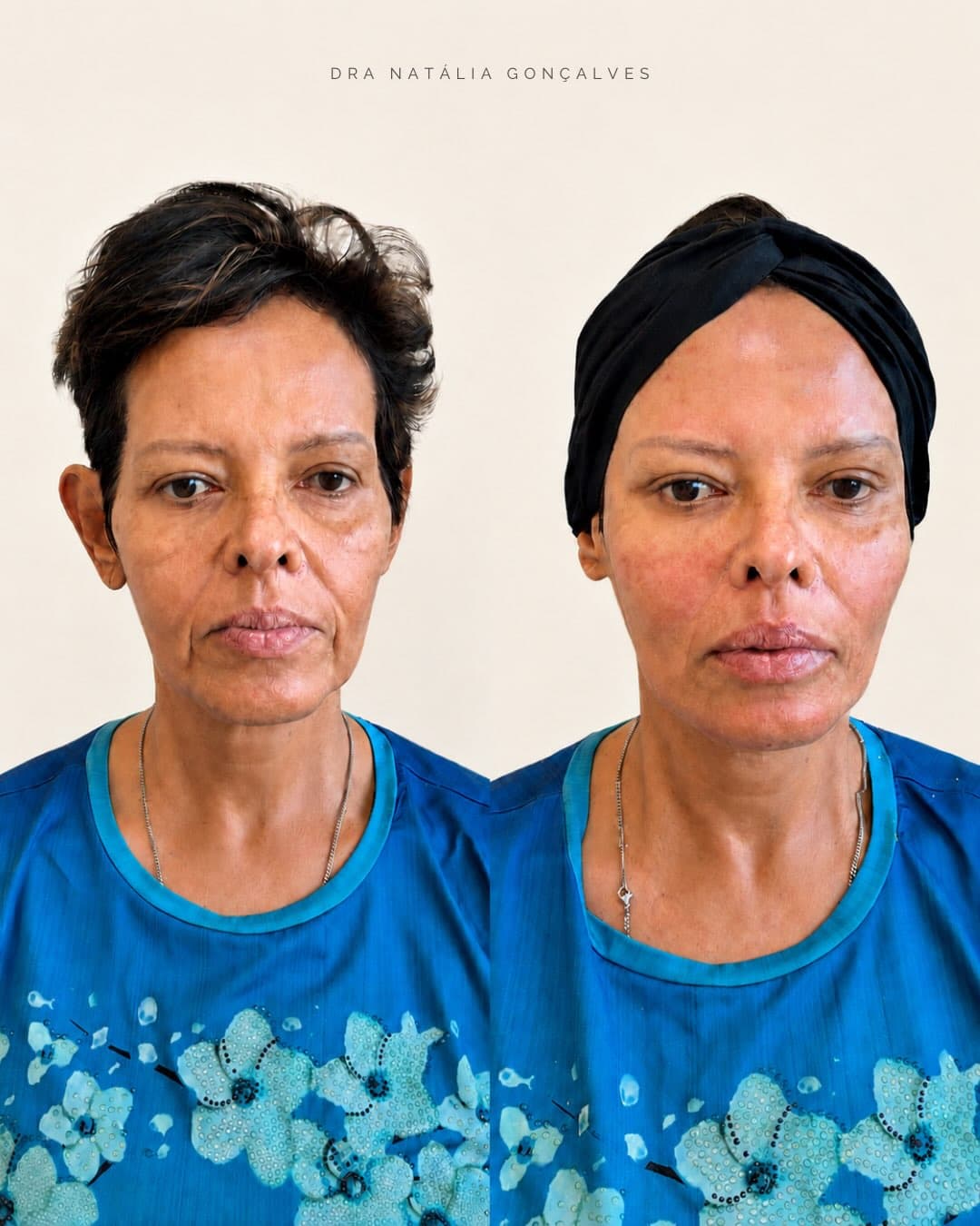 Resultado de Face Lifting feminino acompanhado pela Dra. Natália Gonçalves
