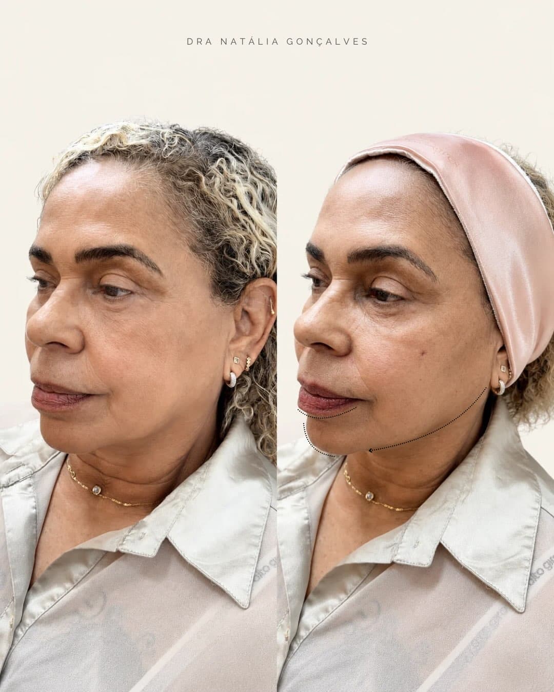 Resultado de rejuvenescimento facial feminino