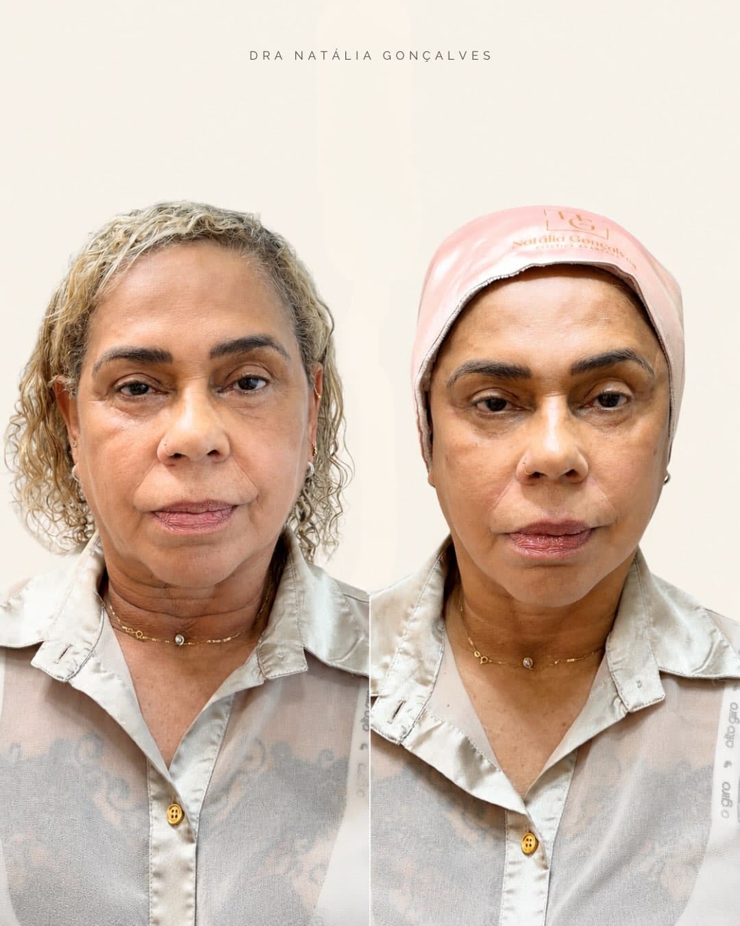 Acompanhamento de rejuvenescimento facial feminino