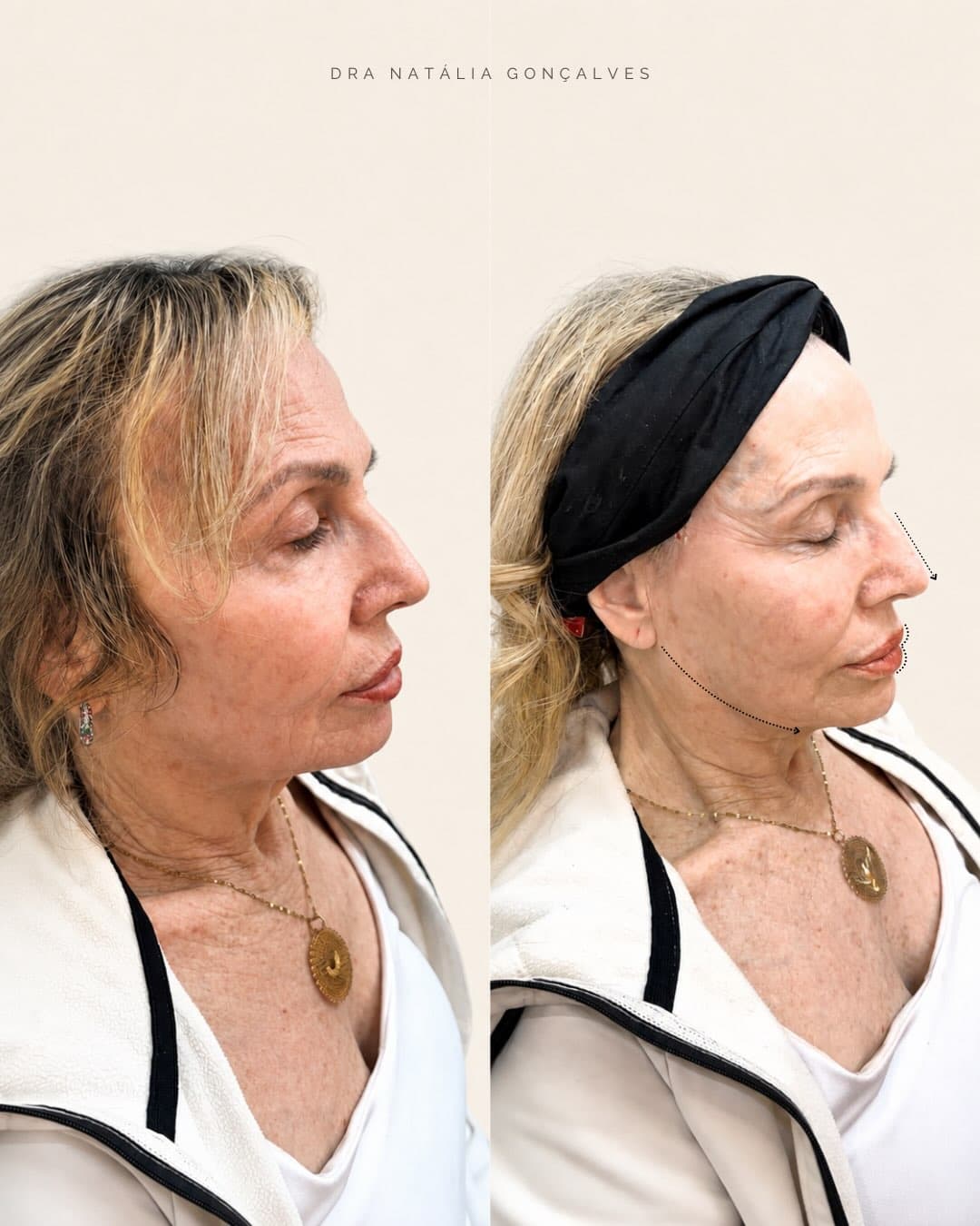 Resultado facial feminino acompanhado pela Dra. Natália Gonçalves