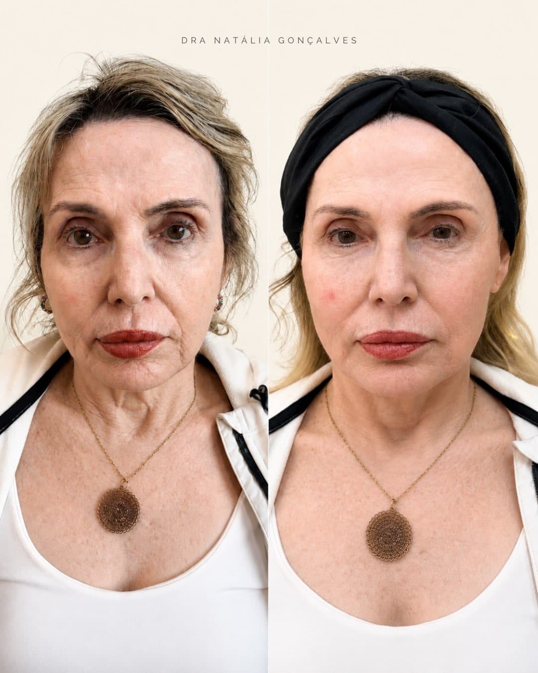 Resultado de rejuvenescimento facial feminino em Belo Horizonte