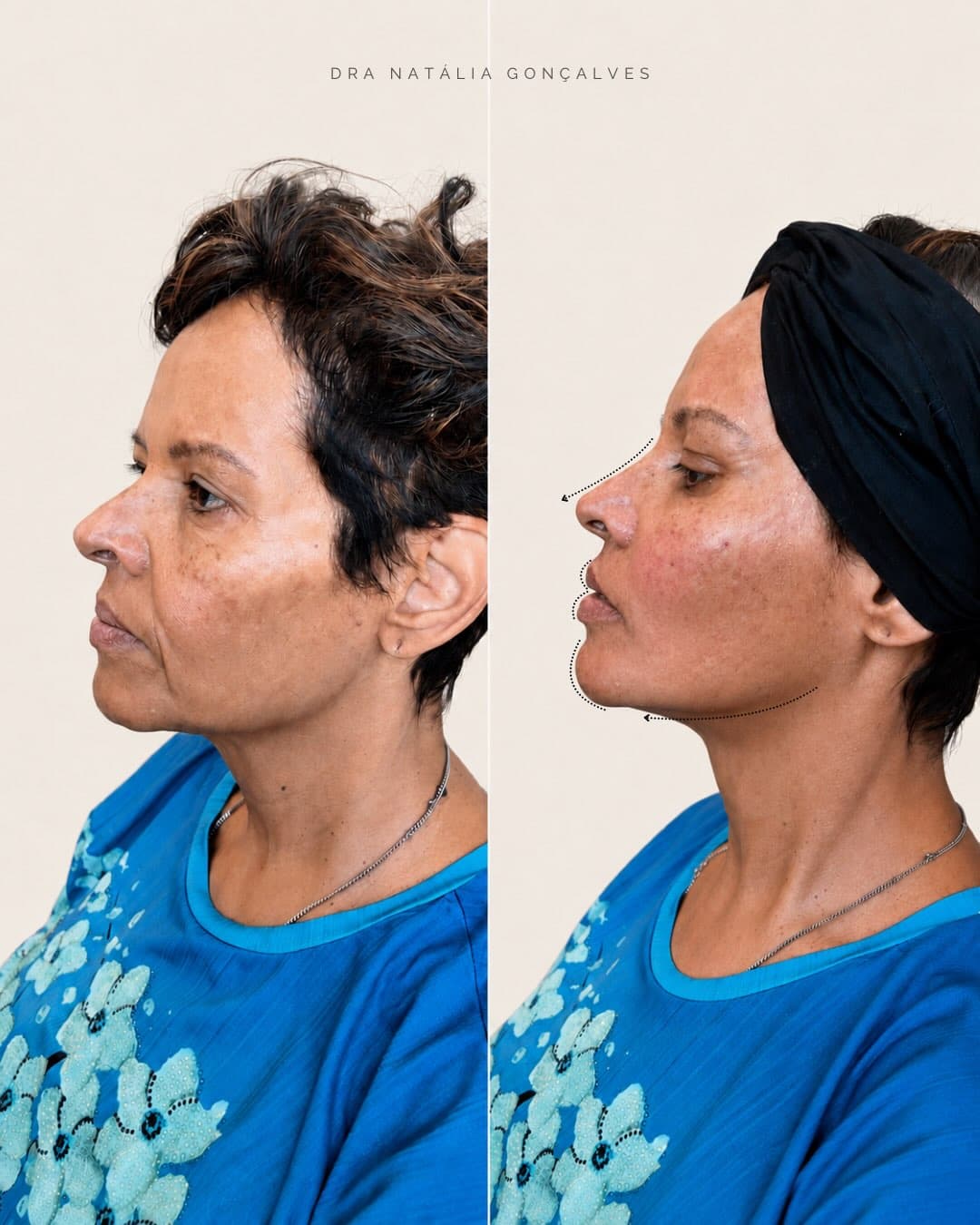 Resultado de Face Lifting feminino em Belo Horizonte