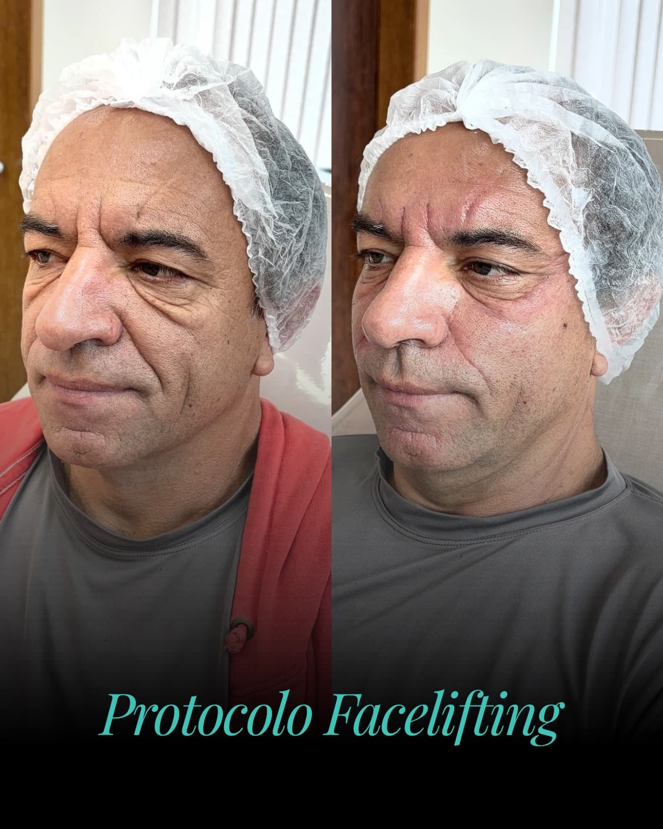 Resultado de Face Lifting masculino acompanhado pela Dra. Natália Gonçalves