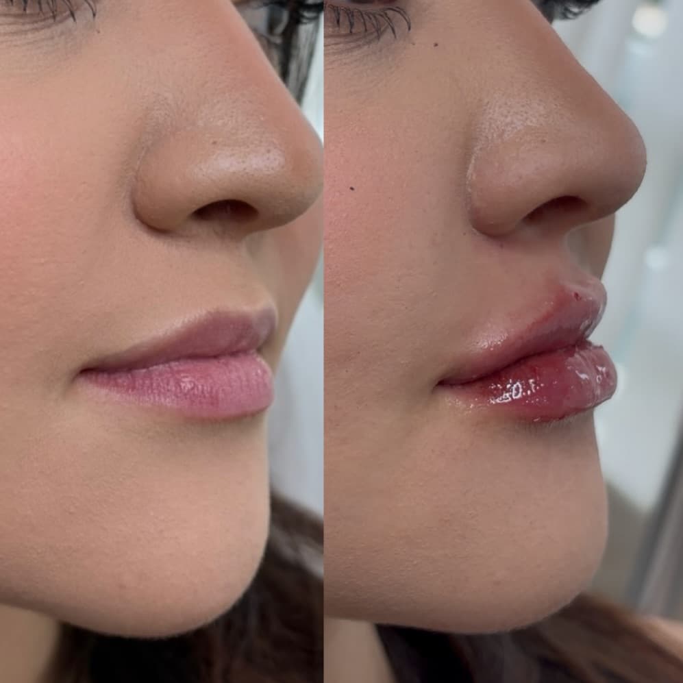 Preenchimento labial acompanhado pela Dra. Natália Gonçalves