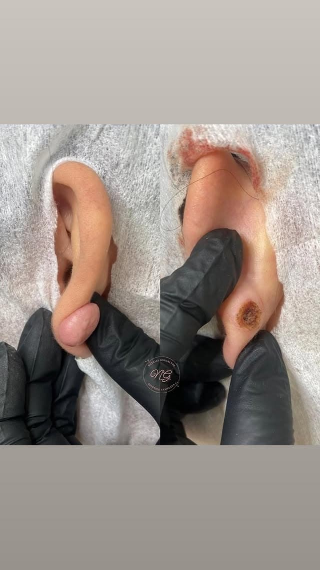 Registro de evolução de queloide
